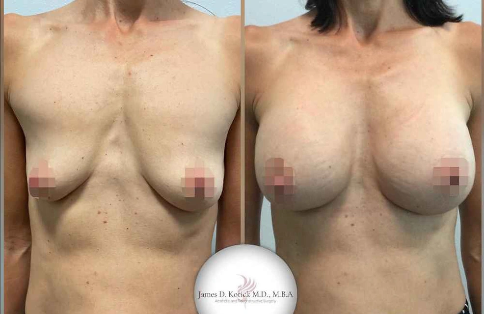 Breast Augmentation — clinical photograph 3 from Envision Plastic Surgery