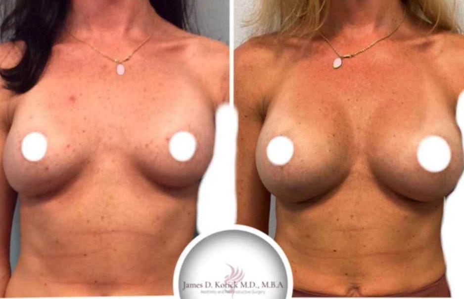 Breast Augmentation — clinical photograph 4 from Envision Plastic Surgery