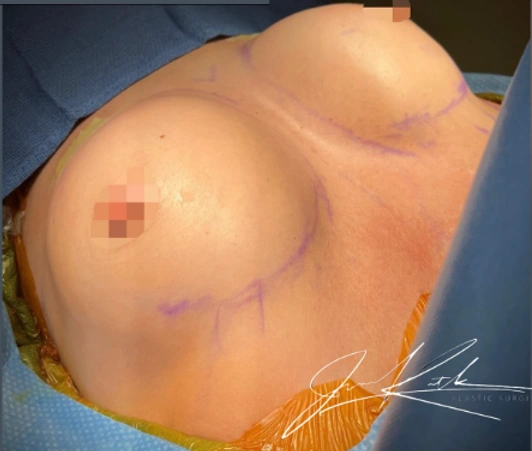 Breast Augmentation — clinical photograph 5 from Envision Plastic Surgery