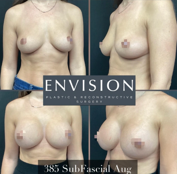 Breast Augmentation — clinical photograph 7 from Envision Plastic Surgery