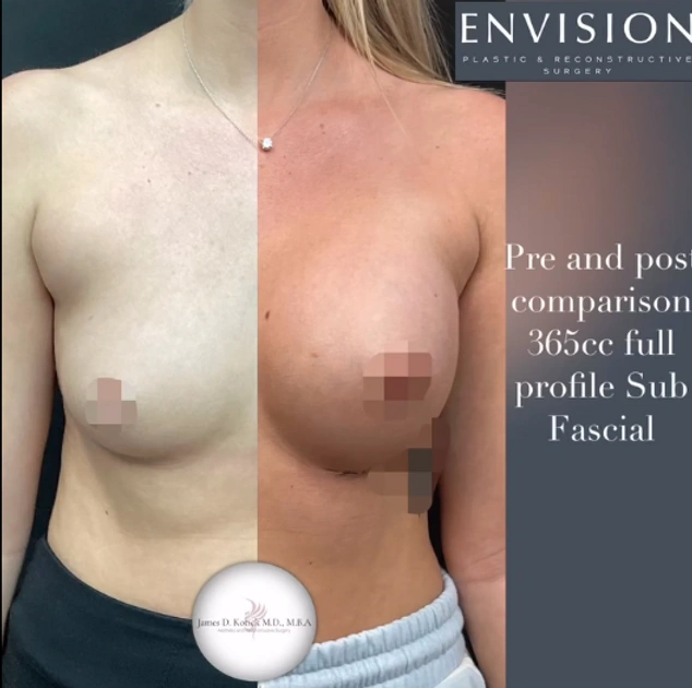 Breast Augmentation — clinical photograph 8 from Envision Plastic Surgery