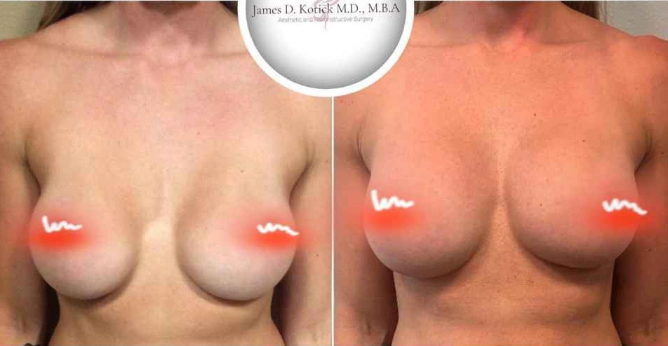 Breast Augmentation — clinical photograph 9 from Envision Plastic Surgery