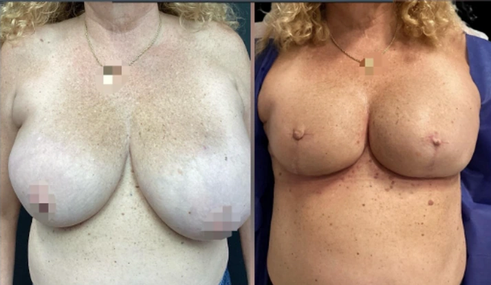 Breast Cancer Reconstruction — clinical photograph 1 from Envision Plastic Surgery
