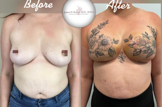 Breast Cancer Reconstruction — clinical photograph 2 from Envision Plastic Surgery