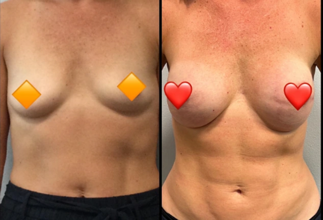 Breast Cancer Reconstruction — clinical photograph 5 from Envision Plastic Surgery