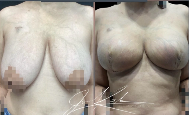 Breast Cancer Reconstruction — clinical photograph 6 from Envision Plastic Surgery