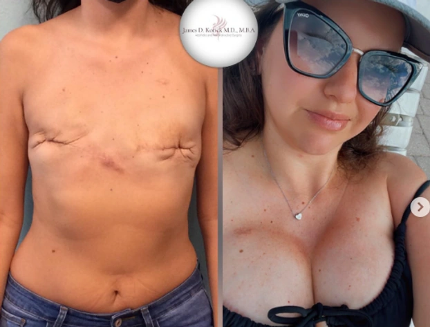 Breast Cancer Reconstruction — clinical photograph 7 from Envision Plastic Surgery