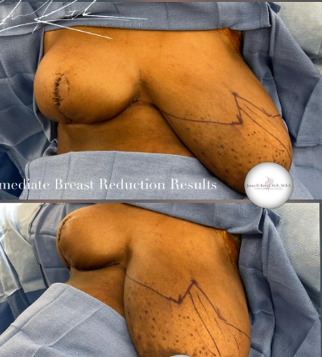 Breast Lifts and Reductions with Signature Auto-Augmentation — clinical photograph 2 from Envision Plastic Surgery