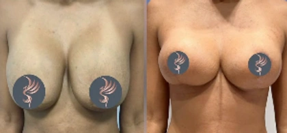 Breast Lifts and Reductions with Signature Auto-Augmentation — clinical photograph 3 from Envision Plastic Surgery