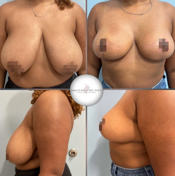 Breast Lifts and Reductions with Signature Auto-Augmentation — clinical photograph 4 from Envision Plastic Surgery