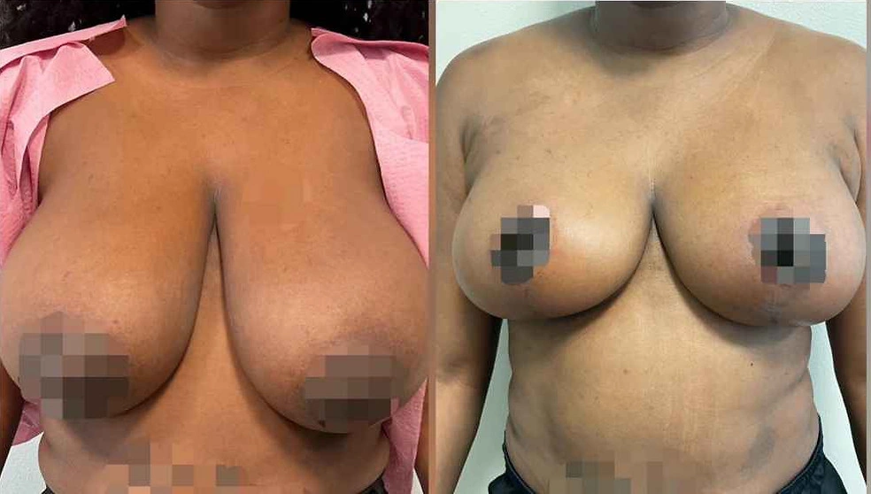 Breast Lifts and Reductions with Signature Auto-Augmentation — clinical photograph 5 from Envision Plastic Surgery