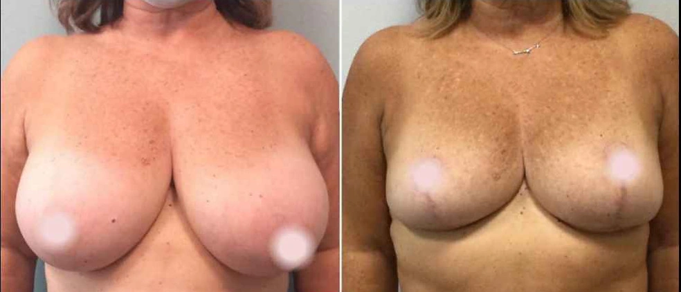 Breast Lifts and Reductions with Signature Auto-Augmentation — clinical photograph 6 from Envision Plastic Surgery