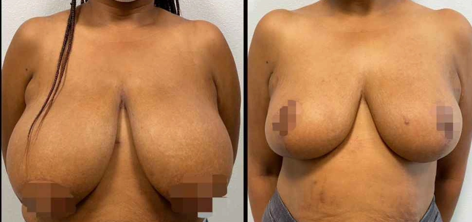 Breast Lifts and Reductions with Signature Auto-Augmentation — clinical photograph 7 from Envision Plastic Surgery