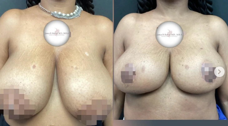 Breast Lifts and Reductions with Signature Auto-Augmentation — clinical photograph 8 from Envision Plastic Surgery