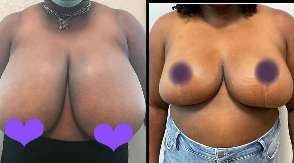 Breast Lifts and Reductions with Signature Auto-Augmentation — clinical photograph 9 from Envision Plastic Surgery