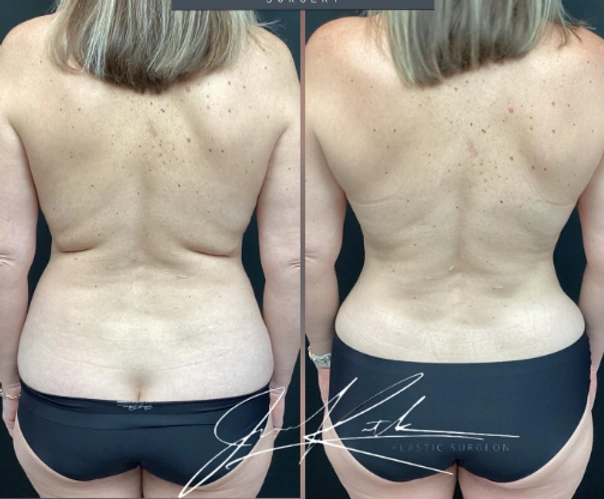Liposuction — clinical photograph 1 from Envision Plastic Surgery