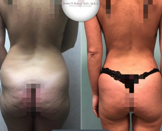 Liposuction — clinical photograph 3 from Envision Plastic Surgery