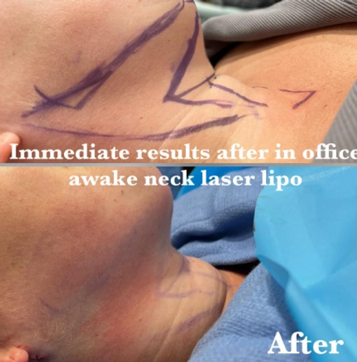 Liposuction — clinical photograph 4 from Envision Plastic Surgery
