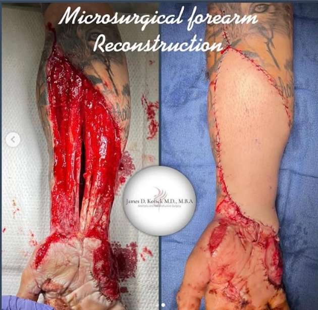 Microsurgical reconstruction — clinical photograph 5 from Envision Plastic Surgery