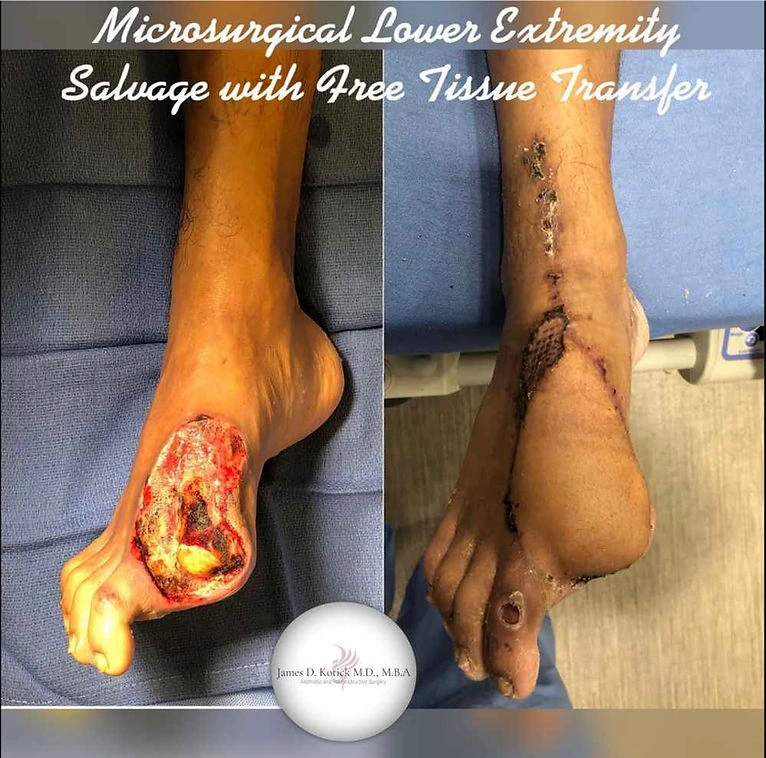 Microsurgical reconstruction — clinical photograph 7 from Envision Plastic Surgery
