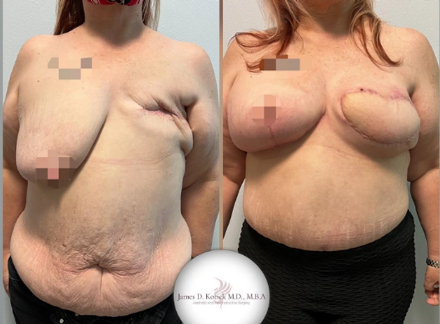 Microsurgical reconstruction — clinical photograph 8 from Envision Plastic Surgery