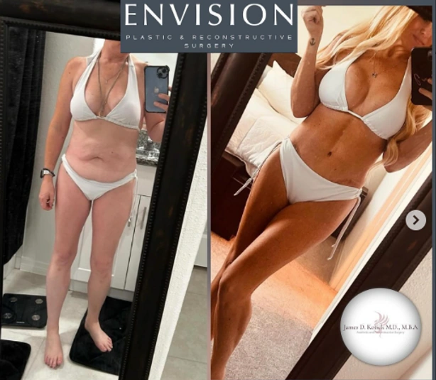 Mommy Makeovers — clinical photograph 1 from Envision Plastic Surgery