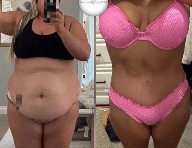 Mommy Makeovers — clinical photograph 2 from Envision Plastic Surgery