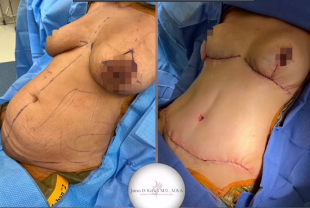 Mommy Makeovers — clinical photograph 3 from Envision Plastic Surgery