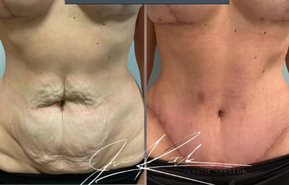 Mommy Makeovers — clinical photograph 4 from Envision Plastic Surgery