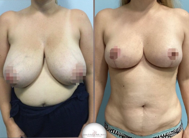 Mommy Makeovers — clinical photograph 5 from Envision Plastic Surgery