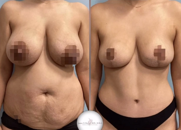 Mommy Makeovers — clinical photograph 6 from Envision Plastic Surgery