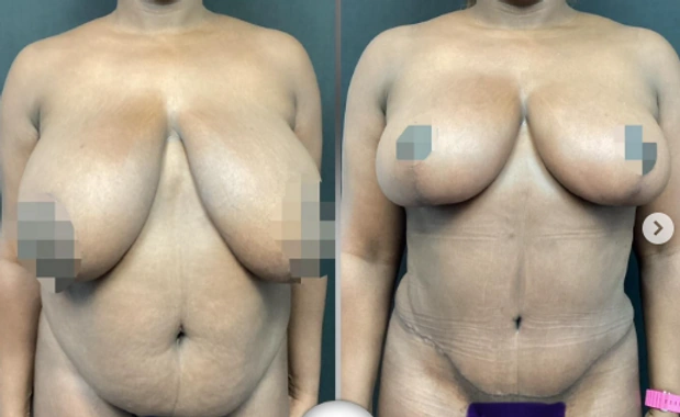Mommy Makeovers — clinical photograph 7 from Envision Plastic Surgery