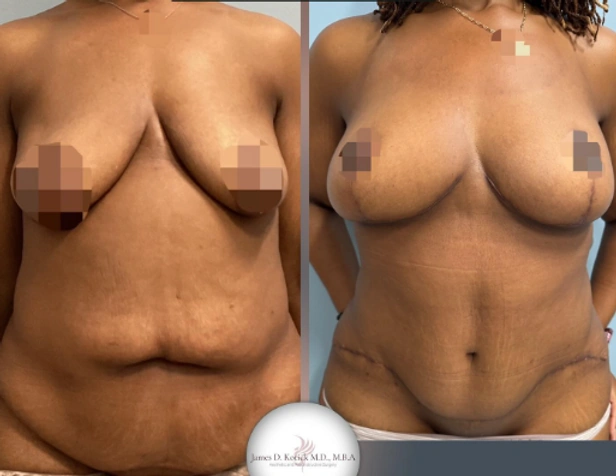Mommy Makeovers — clinical photograph 9 from Envision Plastic Surgery