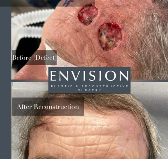 Skin Cancer Reconstruction — clinical photograph 3 from Envision Plastic Surgery