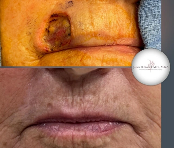 Skin Cancer Reconstruction — clinical photograph 4 from Envision Plastic Surgery