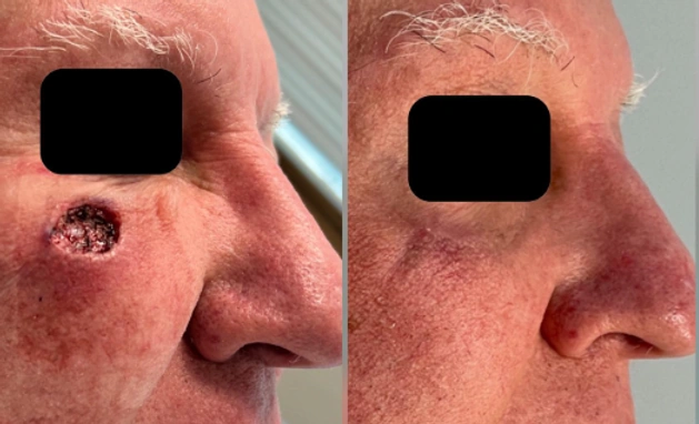 Skin Cancer Reconstruction — clinical photograph 5 from Envision Plastic Surgery