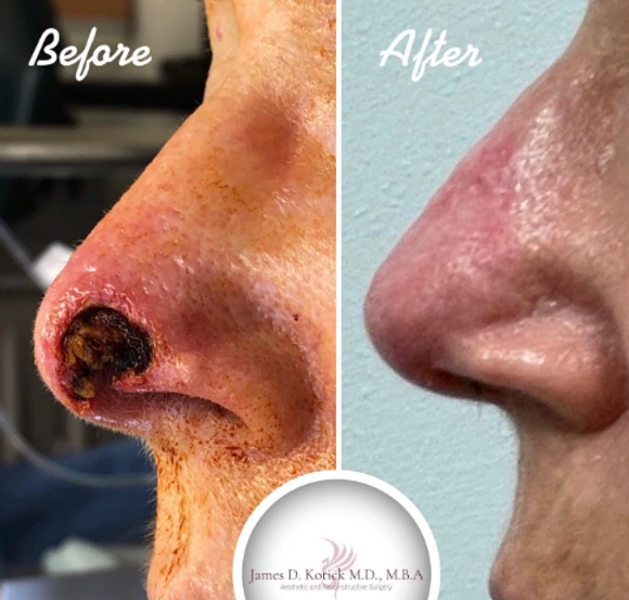Skin Cancer Reconstruction — clinical photograph 6 from Envision Plastic Surgery