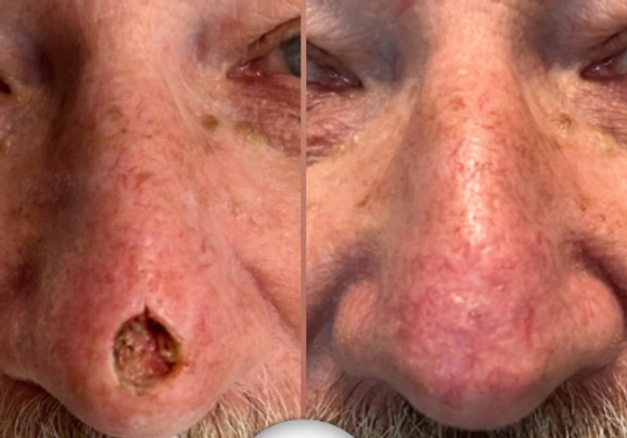 Skin Cancer Reconstruction — clinical photograph 7 from Envision Plastic Surgery