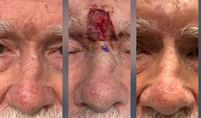 Skin Cancer Reconstruction — clinical photograph 8 from Envision Plastic Surgery