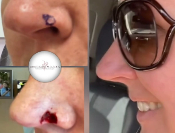 Skin Cancer Reconstruction — clinical photograph 9 from Envision Plastic Surgery