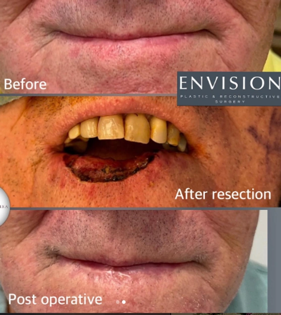 Skin Cancer Reconstruction — clinical photograph 10 from Envision Plastic Surgery