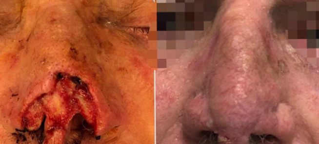 Skin Cancer Reconstruction — clinical photograph 11 from Envision Plastic Surgery