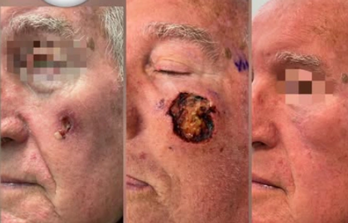 Skin Cancer Reconstruction — clinical photograph 12 from Envision Plastic Surgery