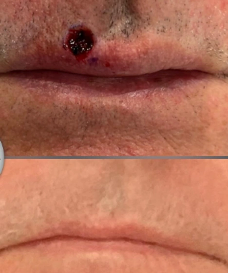Skin Cancer Reconstruction — clinical photograph 13 from Envision Plastic Surgery