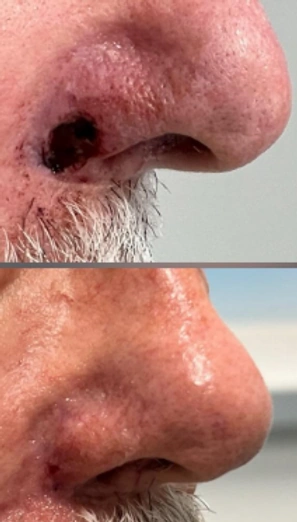 Skin Cancer Reconstruction — clinical photograph 14 from Envision Plastic Surgery