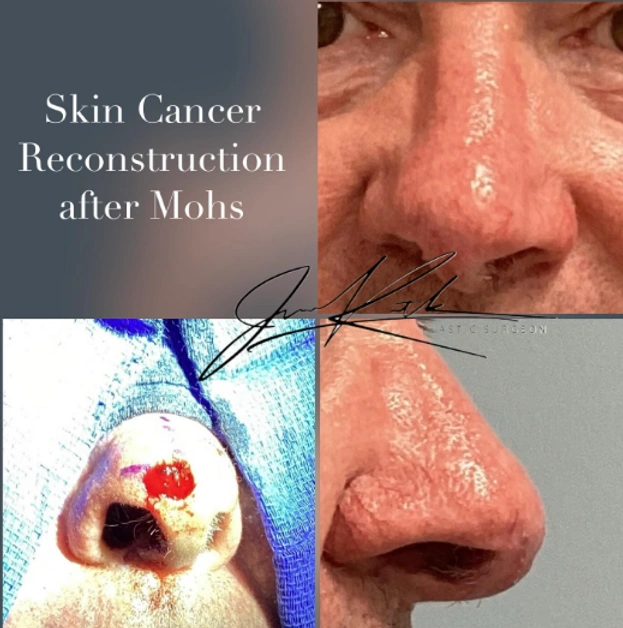Skin Cancer Reconstruction — clinical photograph 15 from Envision Plastic Surgery