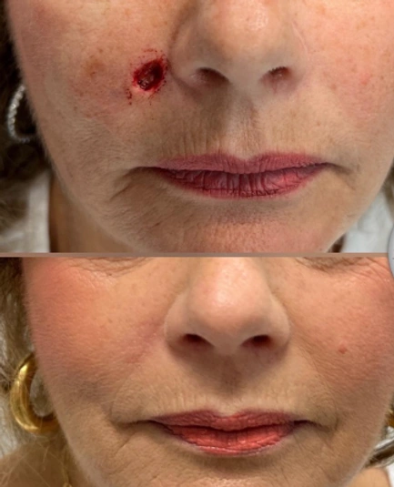Skin Cancer Reconstruction — clinical photograph 1 from Envision Plastic Surgery