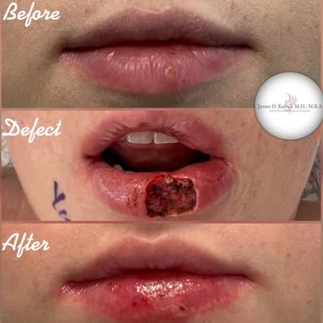 Skin Cancer Reconstruction — clinical photograph 2 from Envision Plastic Surgery
