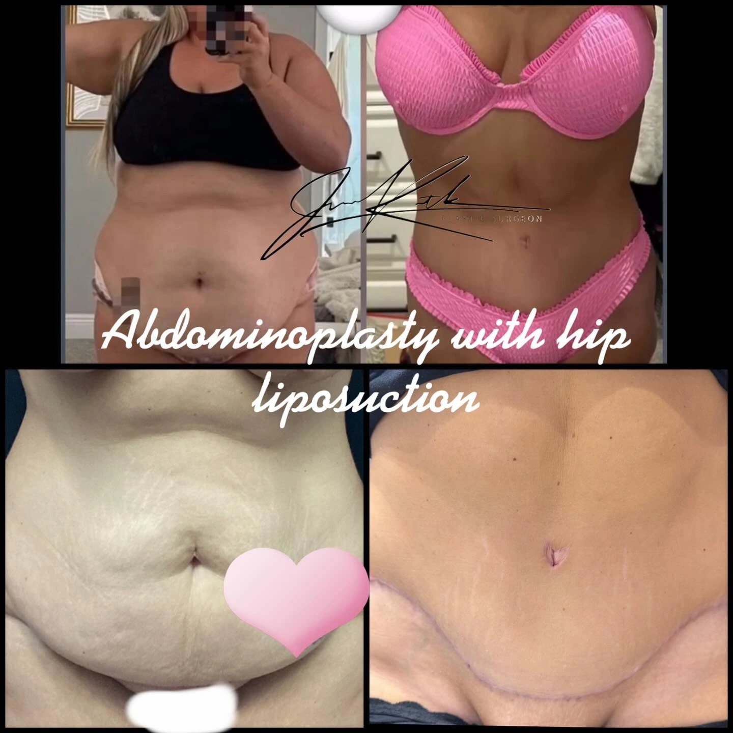 Abdominoplasty with hip liposuction shown before and after.