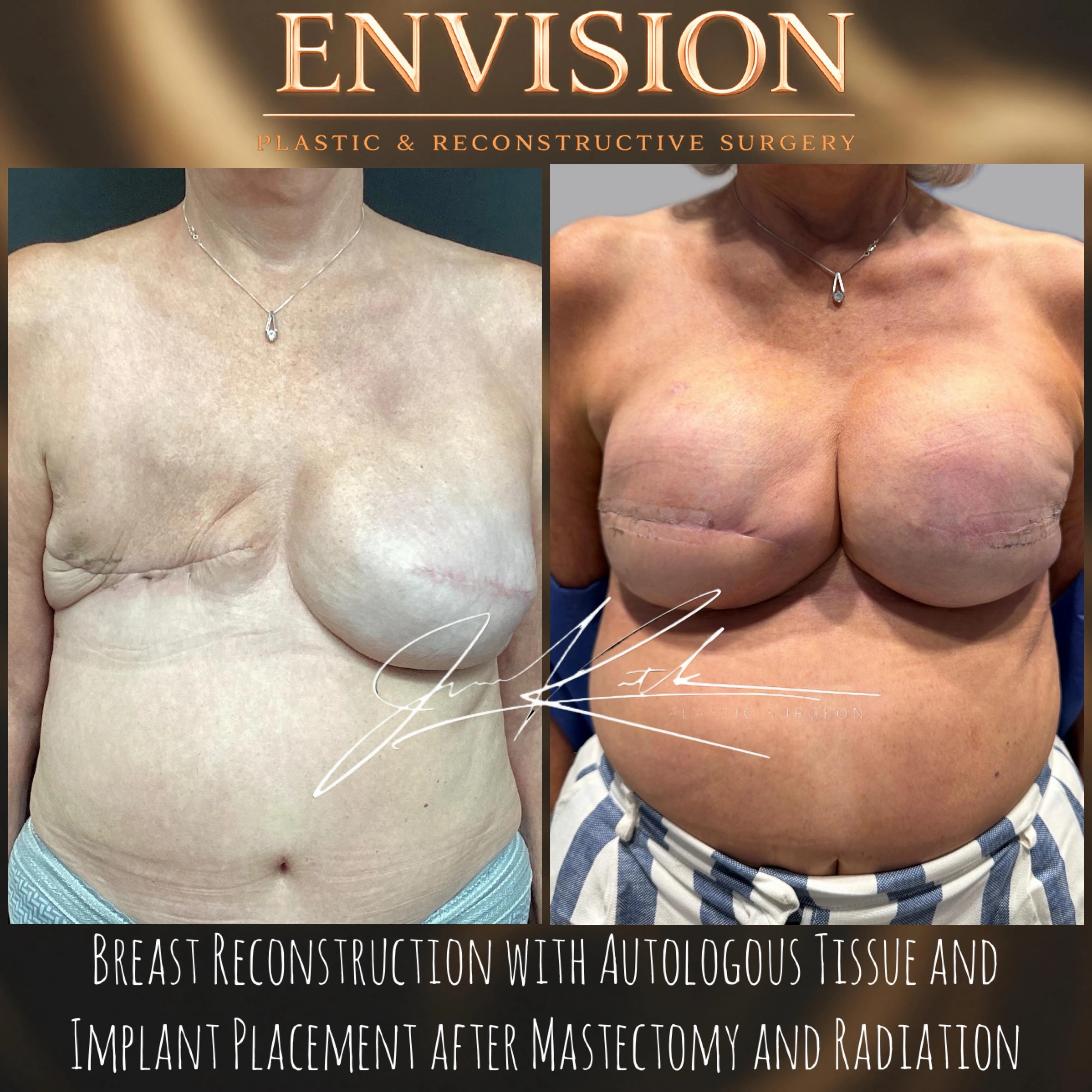 Breast reconstruction using the patient’s own tissue, shown before and after.